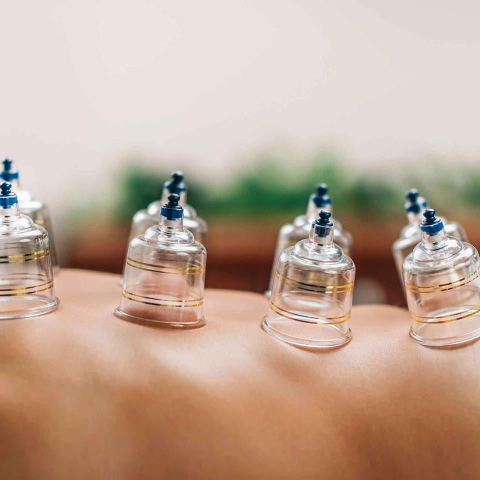 person with plastic therapy cups on their bare back